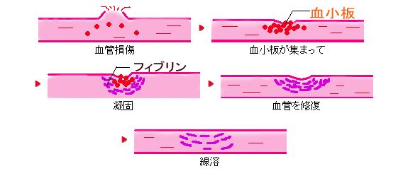 血栓