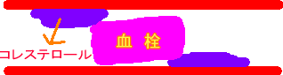 血栓